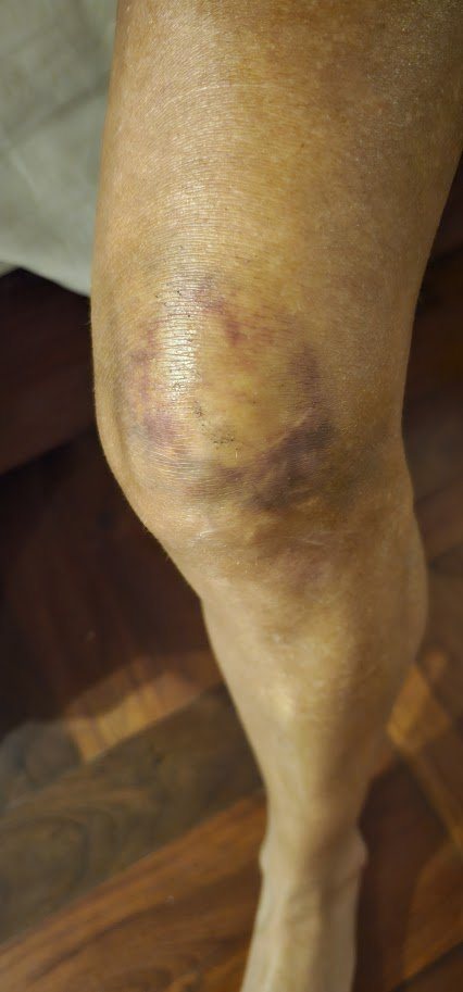 A knee with extensive purple and yellow bruising